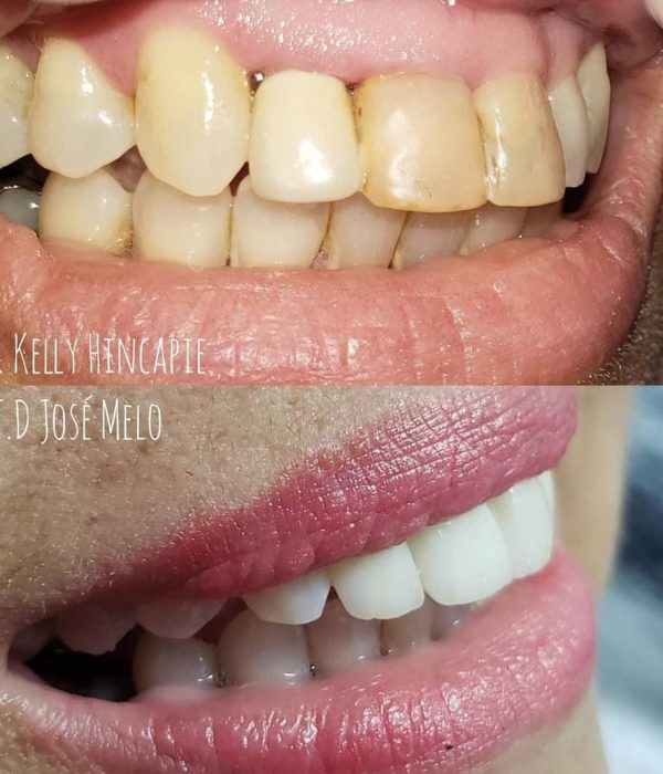 diseño de sonrisa rapido en cali